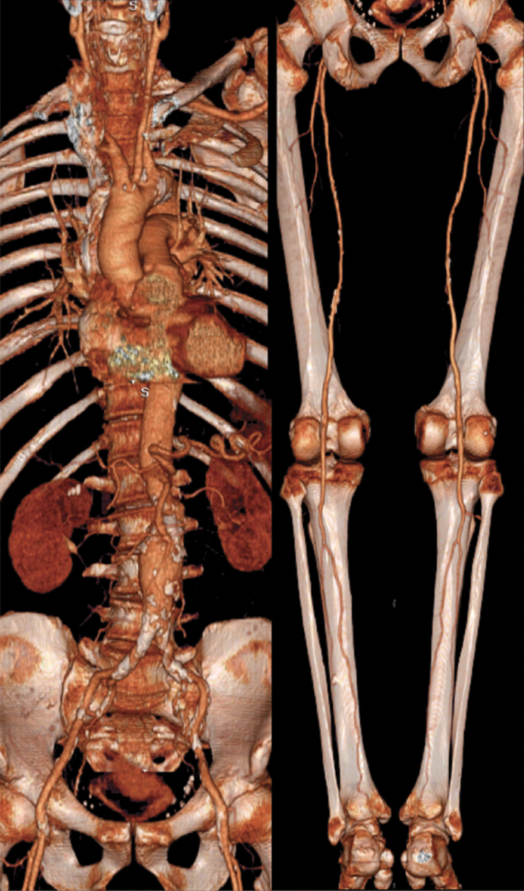 Volume-rendered CT angiogram acquired in 2001 with a single 21-second 16 3 1.25-mm helical scan